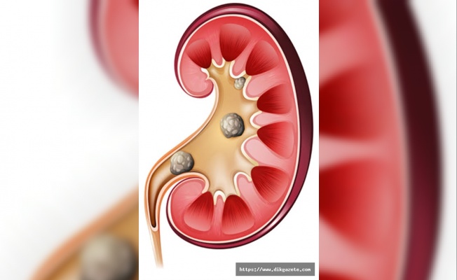 Böbrek taşları, perkütan cerrahi yöntemi ile tedavi edilebiliyor
