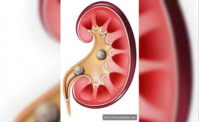 Kronik hastalıklar böbrek sorunlarını tetikliyor
