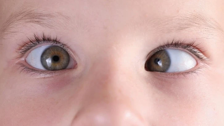 Bebeklerde Göz Kayması Tedavi Yöntemleri Nelerdir?