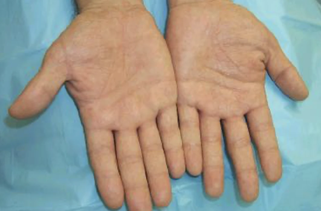 Egzama nedir? -Dağıstanlı Dr. Ayşet Şarifova yazdı-