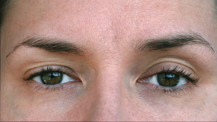 Göz Kapağı Düşüklüğü Ameliyatı Nasıl Gerçekleştirilir?