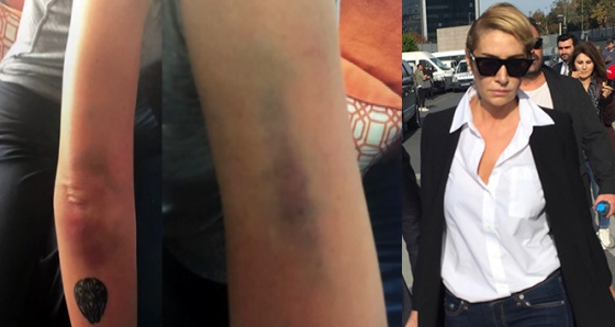 Sıla&#039;nın darp sonucu vücudunda oluşan morlukların fotoğrafları ortaya çıktı