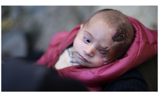 Doğu Guta ablukasından elde kalan simge Kerim bebek Türkiye&#039;de