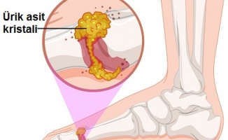 “Menopoz sonrası gut hastalığına dikkat“