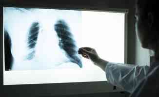 Akciğer kanseri vakalarının yüzde 95&#039;inden sigara sorumlu