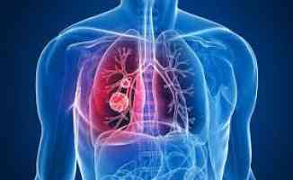 “Akciğer yüksek tansiyonu hayatı tehdit eden bir hastalık“ uyarısı