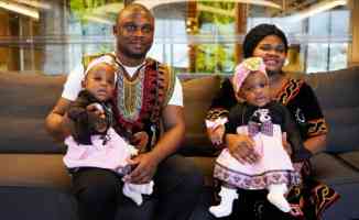 İstanbul&#039;da ayrılan Kamerunlu siyam ikizlerin ailesinden Türkiye&#039;ye teşekkür