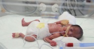 Erciyes&#039;te ve dünyada bir ilk! 750 gram bebeğe operasyon