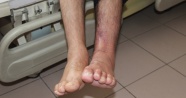 Ayağını makineye kaptırdı, 1 yıllık tedavinin ardından sağlığına kavuştu