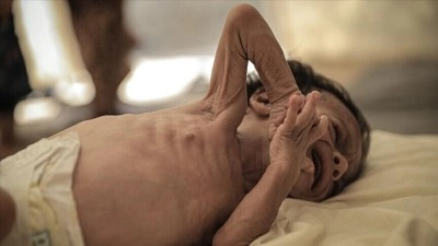 Bangladeş'teki kızamık salgınında hayatını kaybeden &ccedil;ocuk sayısı 779'a &ccedil;ıktı