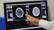 Beyin hücrelerinin yeniden programlanması Parkinson&#039;a çare olabilir