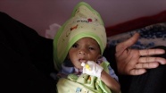 BM: Yemen'in güneyinde 98 bin çocuk yetersiz beslenmeden dolayı ölüm riskiyle karşı karşıya