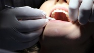 Dişini çektirirken kanına civa karıştı