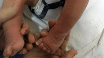 Doğuştan &ccedil;arpık ayak, kararlı tedaviyle normale d&ouml;nebiliyor