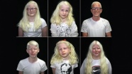 Dünyanın genetik &#039;beyaz&#039;ları: Albinoslar