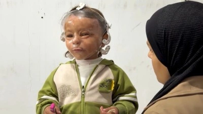 Gazze'de İsrail saldırılarıyla artan yanık mağdurlarının ızdırabı 3D maskeyle hafifletiliyor