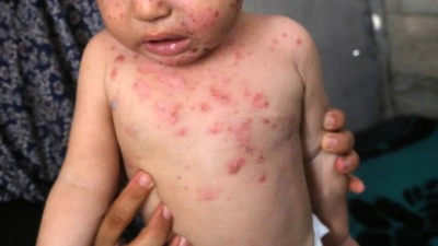 Gazze'de k&ouml;t&uuml; yaşama şartları &ccedil;ocuklar arasında su&ccedil;i&ccedil;eği salgınını b&uuml;y&uuml;t&uuml;yor
