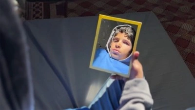 Gazze'de şarapnel nedeniyle g&ouml;z&uuml;n&uuml; kaybeden &ccedil;ocuk, protez g&ouml;zle normal hayatına d&ouml;nmeyi umut ed