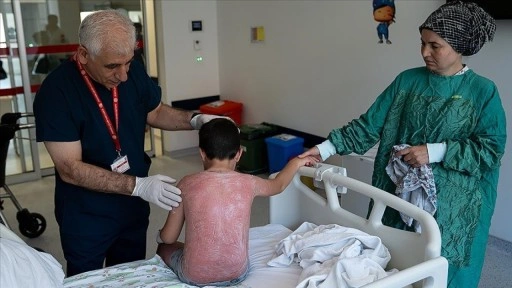 Güneşte 4 saat kalan çocuk, ikinci derece yanıkla hastanelik oldu