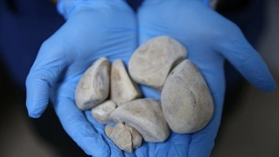 İdrar kanalı ve mesanesinden yarım kilogram ağırlığında 6 taş &ccedil;ıkarıldı