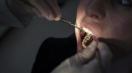 İngiltere’de ülke genelinde diş tedavisi sıkıntısı yaşanıyor