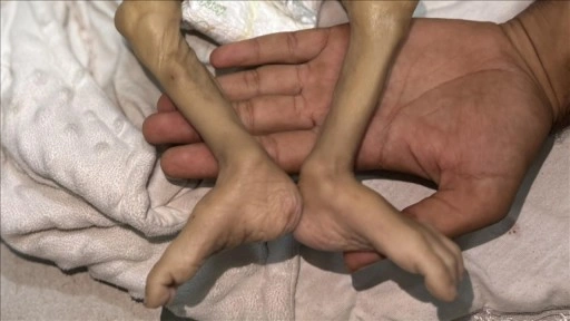 İsrail ablukası altındaki Gazze'de son 24 saatte 2’si çocuk 6 kişi daha açlıktan yaşamını yitir