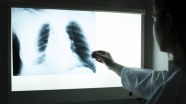 Kovid-19 akciğer hastalarında uzun süreli halsizliğe neden oluyor