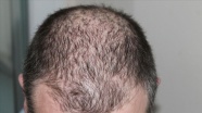 Kovid-19 sonrasında saç dökülmelerinde artış