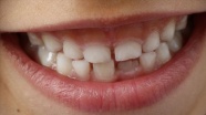 Mine bozukluğunun daimi dişlerde yol açtığı hasarı erken teşhisle onarmak mümkün