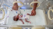 'Mucize bebek' ameliyatla yaşama tutundu