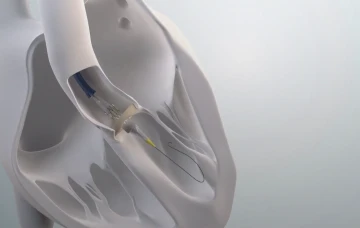 Kalp Sağlığında Modern &Ccedil;&ouml;z&uuml;m, TAVI Ameliyatı