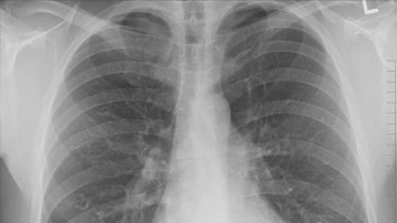 Pasif içicilerde "akciğer kanseri" riski yüzde 30 artıyor