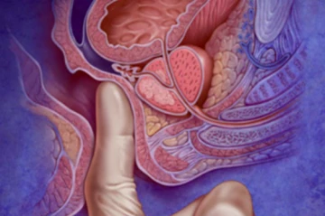 Prostat B&uuml;y&uuml;mesini Doğru &Uuml;r&uuml;nlerle Durdurun