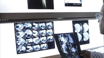 Sağlık Bakanlığı yapay zeka destekli "Mamografi Tarama Raporlama Sistemi" geliştirdi