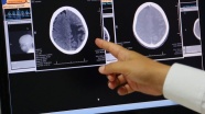 'Türk Beyin Projesi'nin tamamlanmasıyla beyin tümörü sınıflandırması yapabiliyoruz'