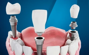 T&uuml;rkiye&rsquo;de İmplant Fiyatları