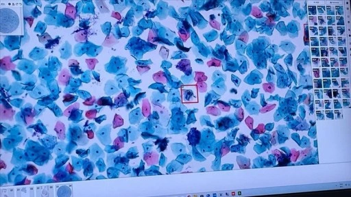 Yapay zeka kanserin erken teşhis ve tedavisinde önemli rol oynuyor