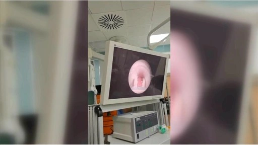 Yutkunamama şikayetiyle hastaneye götürülen çocuğun yemek borusundan et parçası çıktı