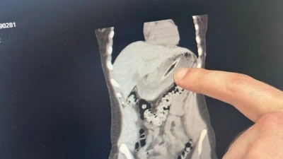 Zayıflamak i&ccedil;in kendini kusturmaya &ccedil;alışırken diş fır&ccedil;ası yuttu